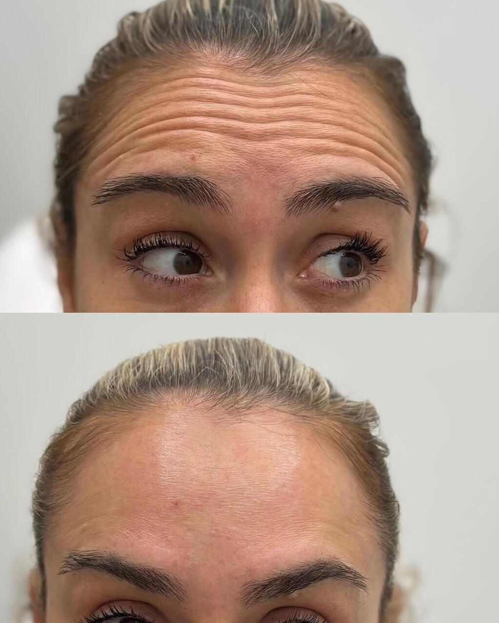 Botox