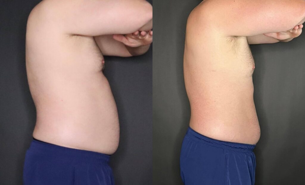 Coolsculpting