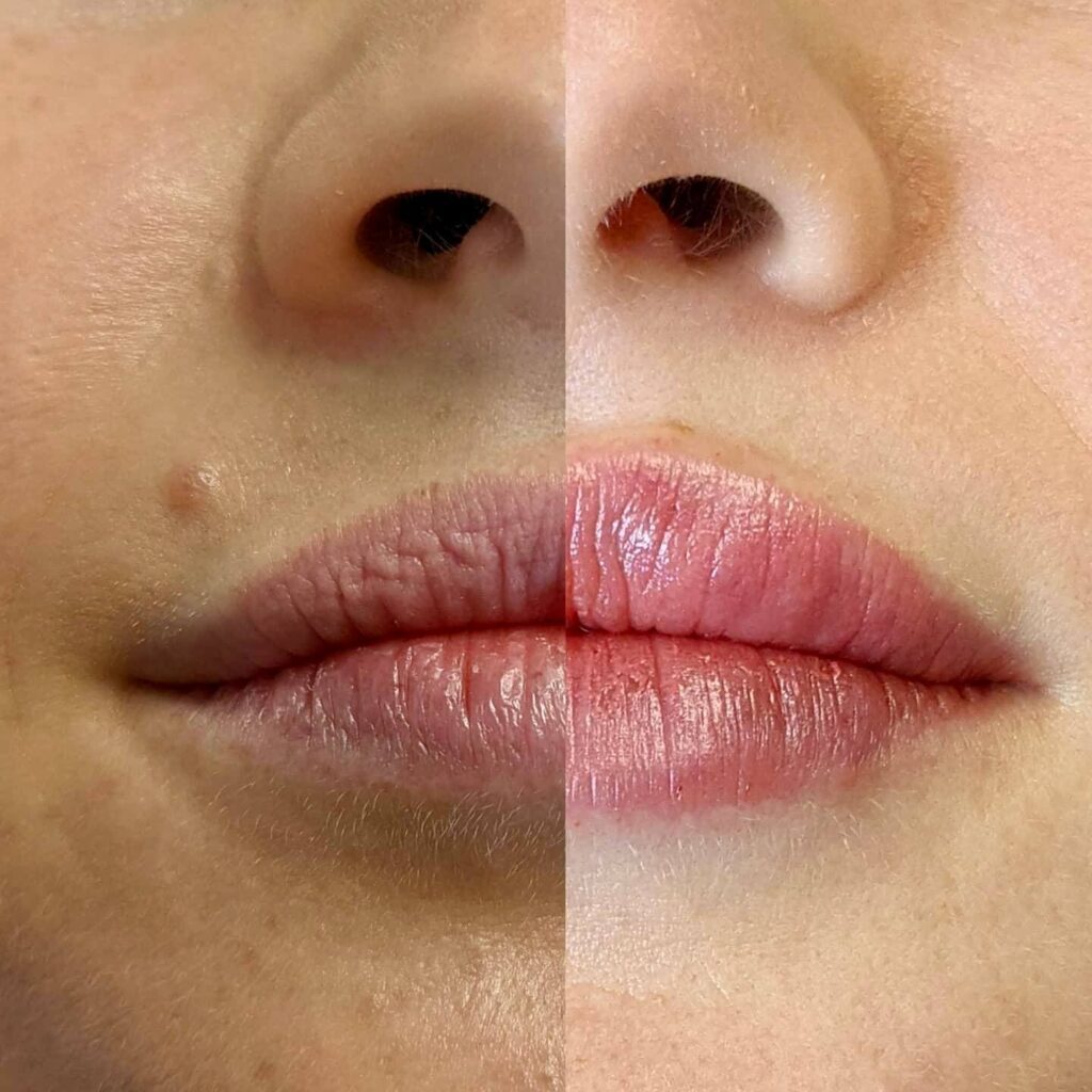 Juvederm