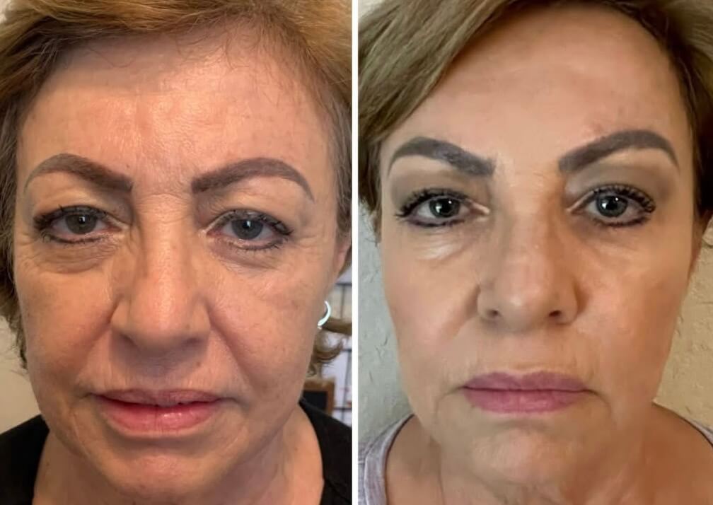 Sculptra